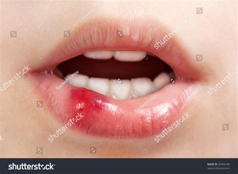 Physical Injury Blood Wound Human Child Stock Photo 59494786 Shutterstock