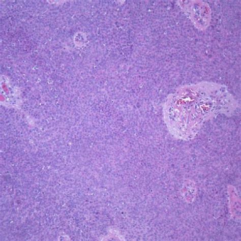 Eccrine Porocarcinoma With Necrosis Area Seen At 20x Magnification