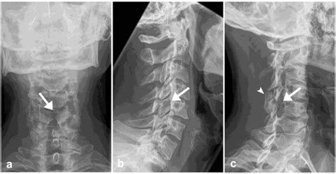 A C Plain Radiographs Of The Cervical Spine Antero Posterior