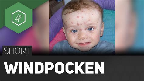 Wer eine erkrankung überstanden hat, ist in der regel lebenslang gegen windpocken immun. 29 Best Photos Windpocken Wann Wieder Kindergarten ...