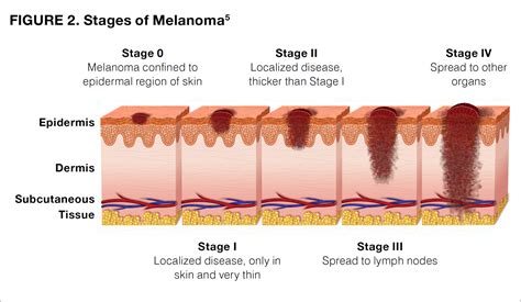 Melanoma Pictures By Stages Stage Melanoma Pictures The Best