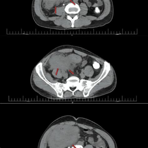 Sections Of Spiral Abdominopelvic Ct Scan With Contrast Show A Large