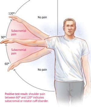 Subacromial Pain Syndrome Physiopedia