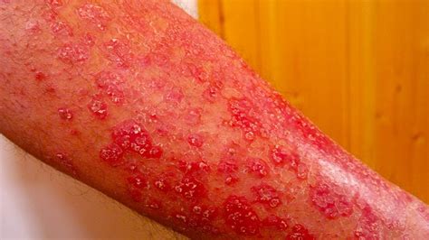 Home Remedies For Inverse Psoriasis Best Treatment For Psoriasis Youtube