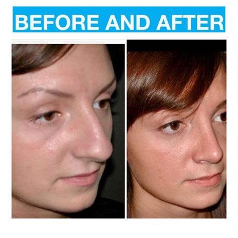 A Before And After Rhinoplasty Procedure From Toronto And Newmarket Surgeon Dr Richard Rival