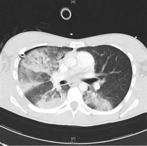 Ct Findings Of The Lung Edema A Bilateral Lung Edema C Open I