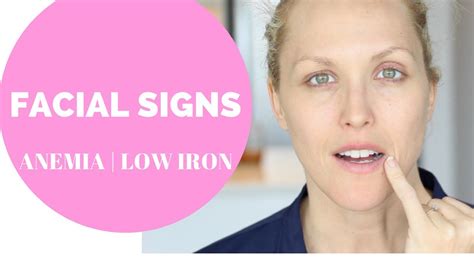 Facial Signs Of Anemia Low Iron Heavy Periods Youtube