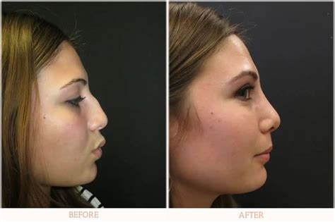 Nose Surgery Dr Carlos Wolf Miami Plastic Surgery