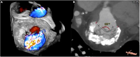 Frontiers Mitral Annular Calcification In Patients With Significant
