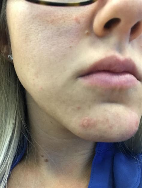 Wateroil Bumps On Chin Only Appears Every Few Weeks Acne R