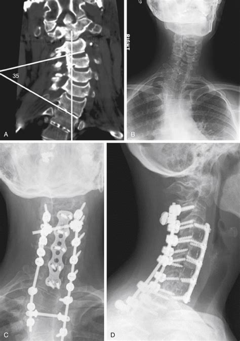 Cervical Deformity And Treatment Algorithms Musculoskeletal Key