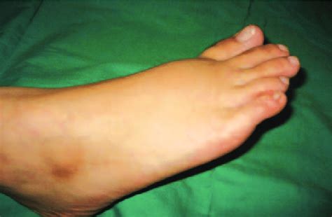 Swelling Over Dorsum Of Right Foot Download Scientific Diagram