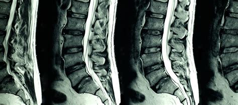 Lumbar Spine Mri I Med Radiology Network