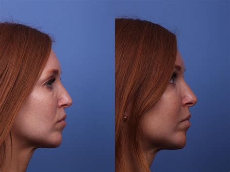 Cheek Implant Before And After Pictures Case 317 Scottsdale And Phoenix