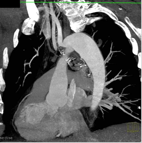 Right Aortic Arch With Aberrant Left Subclavian Artery Chest Case