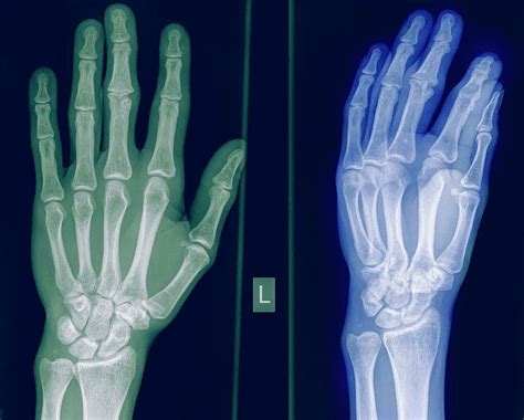 X Ray Of A Healthy Hand Photograph By Photostock Israel