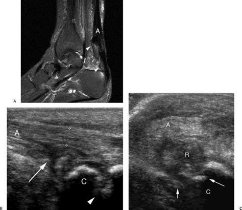 A compromised achilles tendon can cause discomfort from a slight ache, tenderness, and stiffness to severe pain, especially when bending the. Ultrasound for Rheumatoid Arthritis | Radiology Key