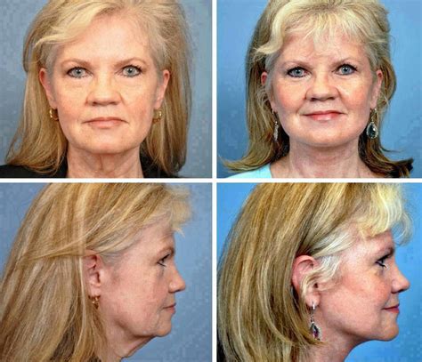 Facelift Lower Face Lift Photos Before And After Facelift Info
