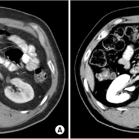 Computed Tomography Ct Scan Demonstrates Multiple Enlarged Lymph