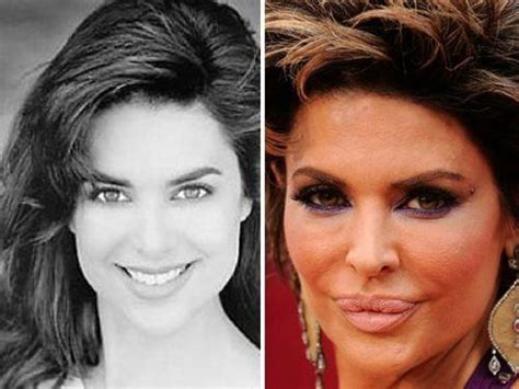 Celebrities Before And After Plastic Surgery Part 1 Musely Vrogue