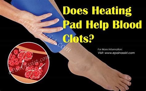 Does Heating Pad Help Blood Clots