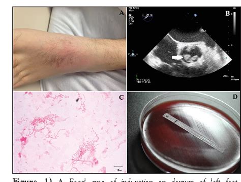 Figure 1 From Subacute Bacterial Endocarditis Caused By Cardiobacterium