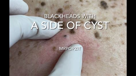 Blackheads With A Side Of Cystblackhead Extractions And Cyst Excision