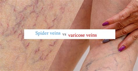 Varicose Veins Vs Spider Veins The Difference Gilvydis Vein Clinic My XXX Hot Girl