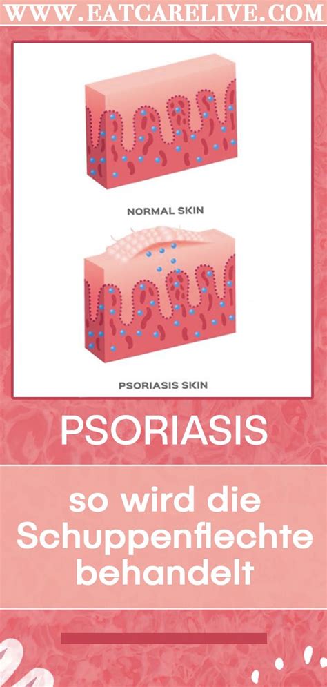 Psoriasis So Wird Die Schuppenflechte Behandelt Schuppenflechte