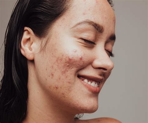 All The Facts On Hormonal Acne Treatment Nz