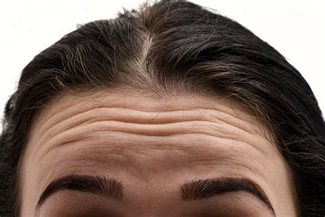 Forehead Wrinkles Home Remedies And Self Care Emedihealth