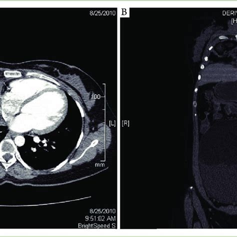 A Ct Scan Axial View Of Chest At Level Of Cardia Showing A Well