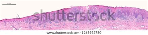 Skin Keratosis Showing Acanthosis Thickening Epidermis Stock Photo