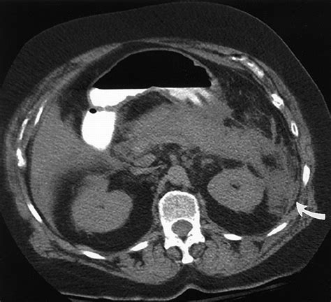 Imaging Diagnosis Of Cystic Pancreatic Lesions Pseudocyst Versus