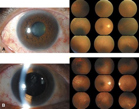 Severe Intraocular Inflammation After Intravitreal Injection Of