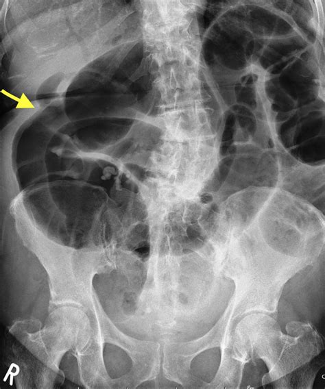 Gallstone Ileus Of The Sigmoid Colon An Extremely Rare Cause Of Large