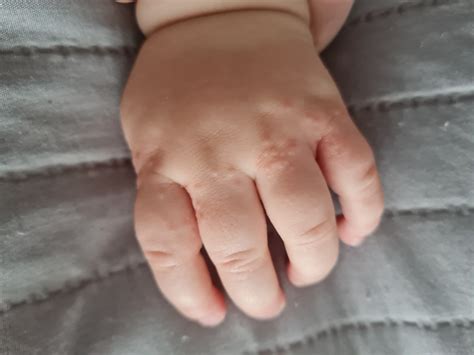 Сыпь и покраснение на руках у ребёнка Вопрос детскому дерматологу