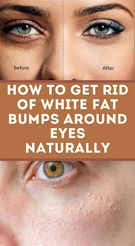How To Get Rid Of White Fat Bumps Around Eyes Naturally Health And