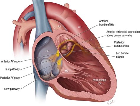 Unusual Atrioventricular Reentry Tachycardia In Congenitally Corrected