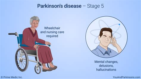 Slide Show Understanding Parkinsons Disease