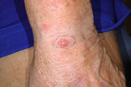 It usually develops as a single. Skin cancer types: Merkel cell carcinoma signs & symptoms