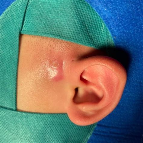 Surgery For Preauricular Fistula Removal With Methylene Blue