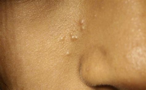 Small Bumps That Arent Pimples On Face General Acne Discussion