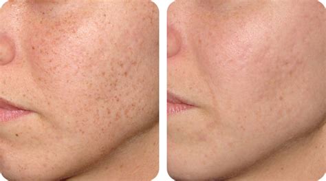 before and after﻿ skintuition medical aesthetic clinic