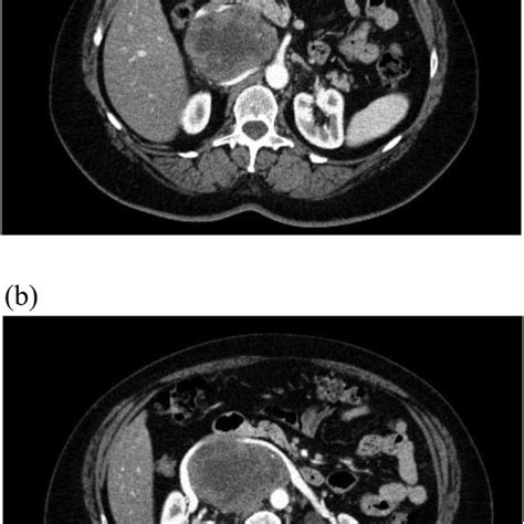 The Ct Examination After Intravenous Contrast Administration