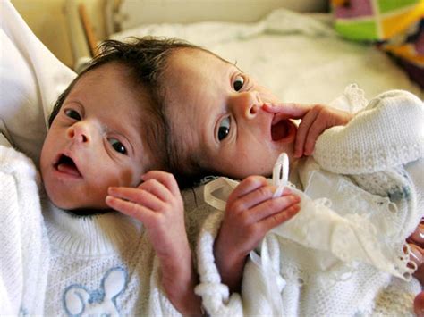 Conjoined Twins Conjoined Twins Warning Graphic Images Pictures