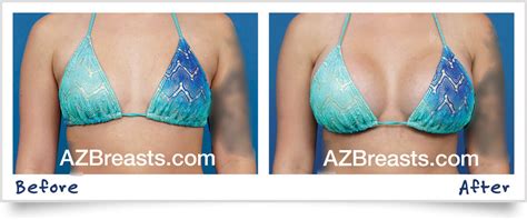 How To Choose Breast Implant Size Ademploy