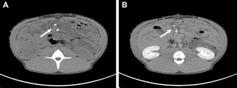 Contrast Enhanced Computed Tomography Ct Scan Showing Irreversible