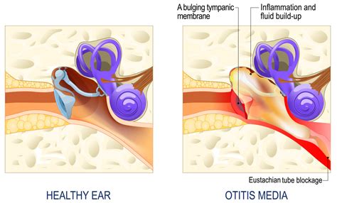 Middle Ear Infections And Glue Ear — Ent Surgeon East Sydney Edgecliff Dr Marco Raftopulos