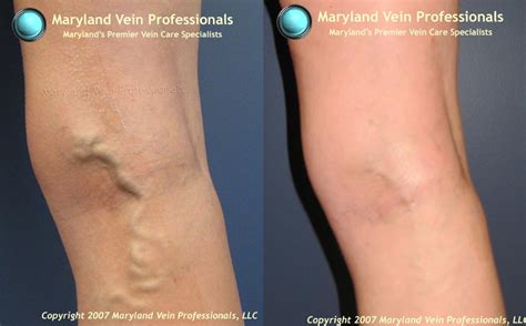 Why Varicose Veins Are Dangerous As Well As Painful
